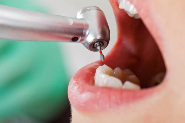 Best Emergency Tooth Extraction  in Hilmar Irwin, CA